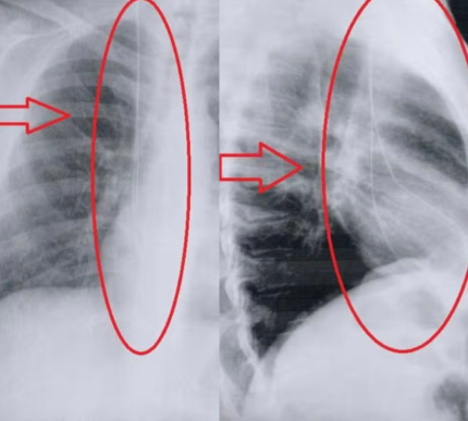 Fio-guia esquecido no corpo de Vanes . Exame de raios X. Foto: montagem/ reprodução.