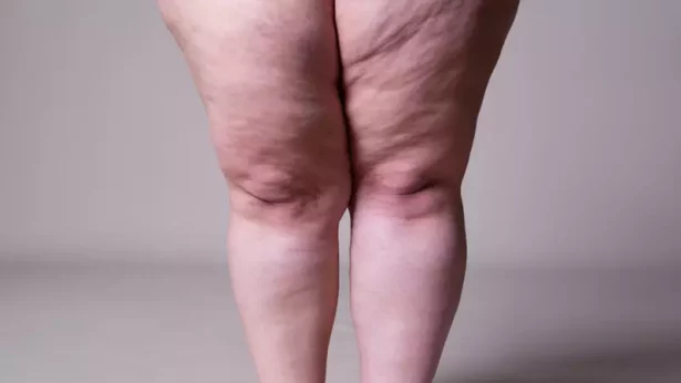 Dieta para lipedema? Veja alimentos que podem ajudar nos sintomas