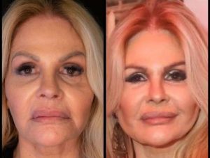 Antes e depois da harmonização facial de Monique Evans