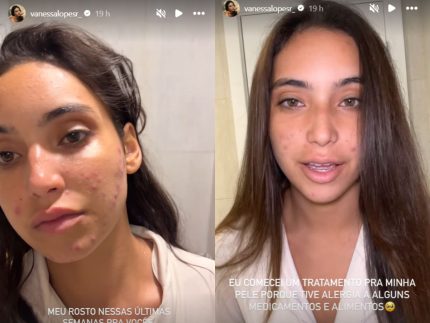 De cara limpa, Vanessa Lopes desabafa sobre acne e saúde mental