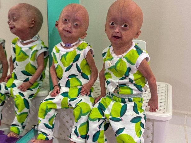 Elis, uma das gêmeas brasileiras diagnosticadas com síndrome rara, morre aos 5 anos