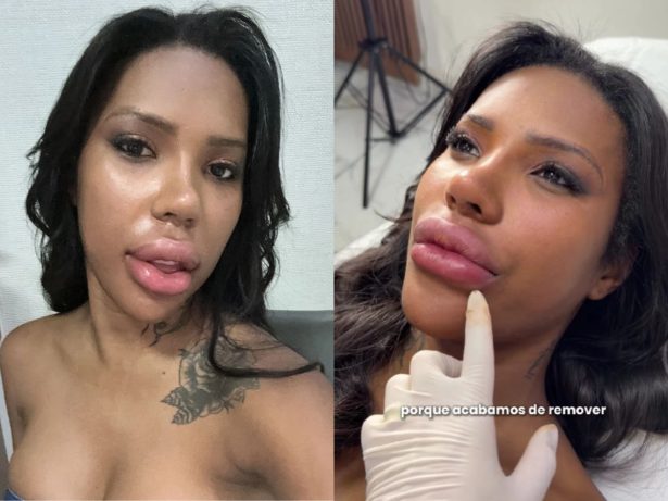 Carol Lekker assusta seguidores com lábios inchados e revela o que aconteceu