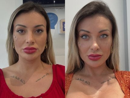 Andressa Urach segue os passos de Maya e muda cor dos olhos com cirurgia: “Sonho”