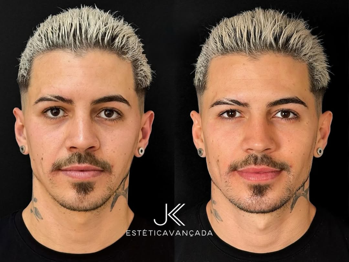 Biel - Divulgação/JK Estética Avançada