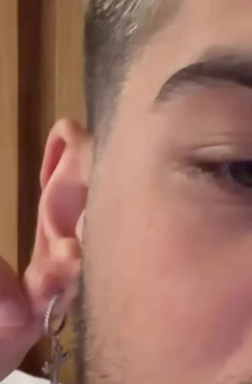 Zé Felipe mostrou como ficou a orelha após o machucado. (Reprodução: Instagra)