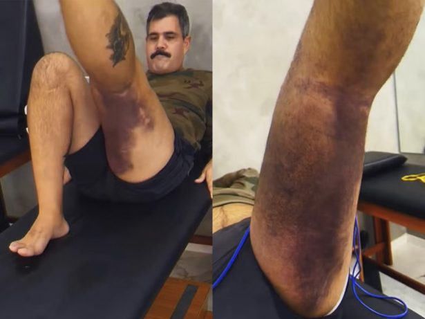 Juliano Cazarré passa por reabilitação após nova cirurgia e expõe hematomas
