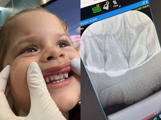 Após acidente, Maria Flor coloca aparelho dentário e Virginia atualiza adaptação