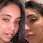 Acne severa: especialista orienta melhor tratamento em casos como o de Vanessa Lopes