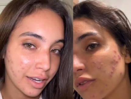 Acne severa: especialista orienta melhor tratamento em casos como o de Vanessa Lopes