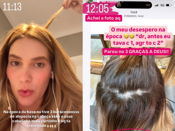 Após mudança de visual, Virginia relembra queda de cabelo e alopecia