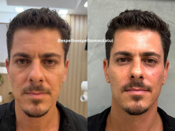 Sacha Bali passa por harmonização facial e mostra antes e depois