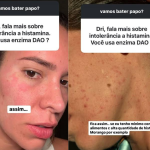 Intolerância à histamina: entenda doença que atingiu Adriana Sant’Anna