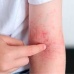 Cuidado com a pele: especialista explica sintomas e tratamento da dermatite atópica