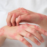 Dermatite atópica: SUS disponibiliza três novos medicamentos para a doença