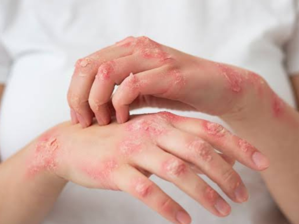 Dermatite atópica: SUS disponibiliza três novos medicamentos para a doença