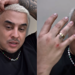 Kauan mostra ferimentos após cair durante show e confessa: “Fiquei com vergonha”