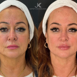 Médico detalha procedimento de rejuvenescimento feito por Nadine, mãe de Neymar