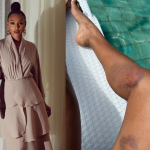 Sheron Menezzes mostra hematomas após acidente com bicicleta elétrica: “Toda roxa”