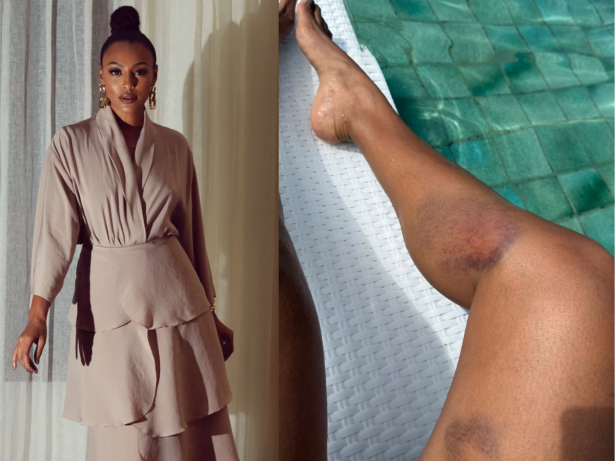 Sheron Menezzes mostra hematomas após acidente com bicicleta elétrica: “Toda roxa”