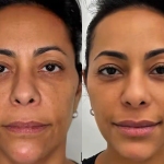 Samantha Schmutz faz procedimentos com médico das Kardashians; veja antes e depois