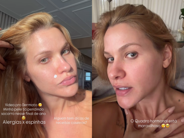 Andressa Suita revela incômodo com a pele: “Realidade de quem está tentando engravidar”