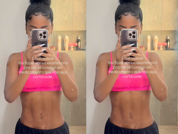 Após revelar doença autoimune, Lorena Maria mostra manchas na barriga