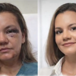 Mulher agredida com 61 socos pelo namorado mostra resultado de reconstrução facial