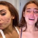 Como funciona o tratamento para acnes como as de Vanessa Lopes; especialista tira dúvidas