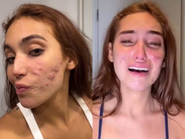 Como funciona o tratamento para acnes como as de Vanessa Lopes; especialista tira dúvidas