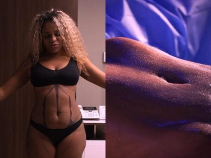 Ex-natural, Cariúcha mostra antes e depois com resultado de lipo LAD