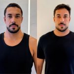 Ex-BBB Maike Allan faz harmonização facial e explica receio de perder a naturalidade