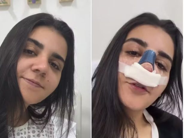 Recém-solteira, Yasmin Santos faz rinoplastia : “Recomendações médicas”