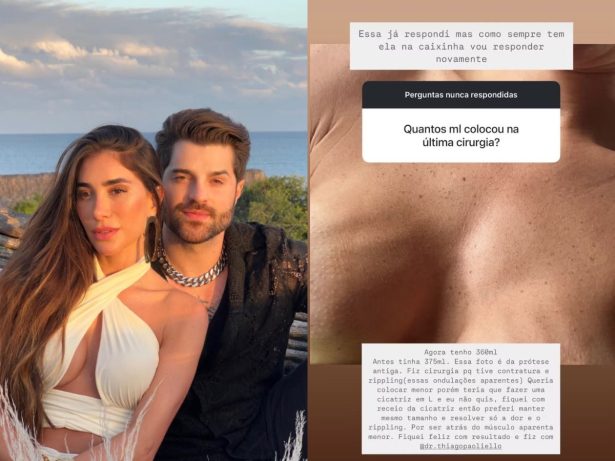 Romana Novais mostra “ondulações” nos seios após complicações com prótese de silicone
