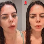 Grávida, ex-Casamento às Cegas sofre grave acidente e exibe queimaduras