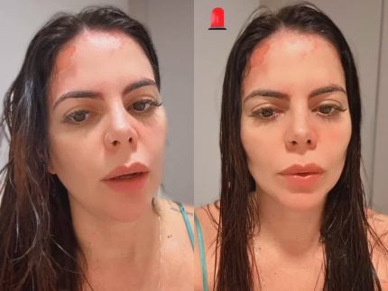 Grávida, ex-Casamento às Cegas sofre grave acidente e exibe queimaduras