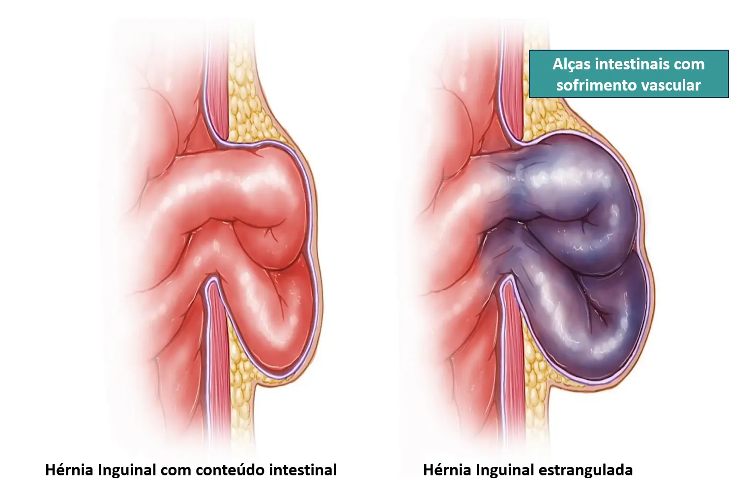 Hernia estrangulada