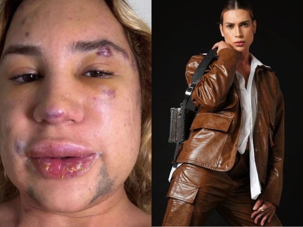 Influenciador de moda morre por complicações após procedimento estético