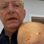 Âncora da Globo é atacado por pitbull em SP e faz desabafo sobre irresponsabilidade