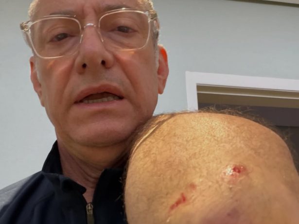 Âncora da Globo é atacado por pitbull em SP e faz desabafo sobre irresponsabilidade