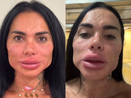 Kamila Simioni surpreende ao mostra resultado de nova harmonização facial