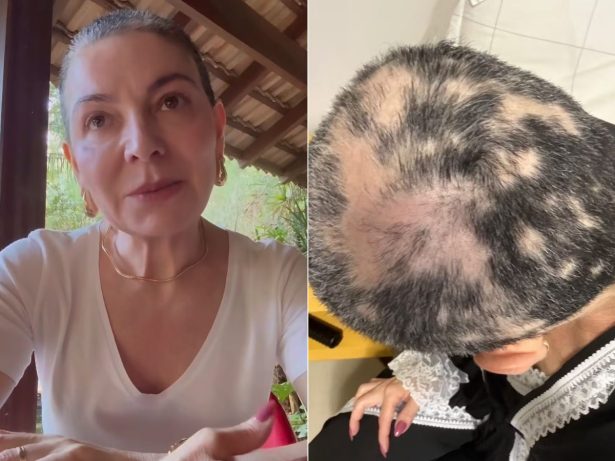 Após melhora, mãe de Lucas Lucco lamenta recaída de alopecia severa: “Mais triste”