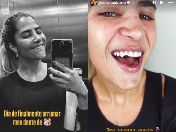 Filha de Leonardo, Jéssica Beatriz mostra dente quebrado após queda: “Dentes de rato”