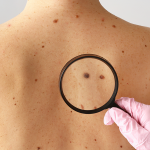 Melanoma: câncer de pele mais agressivo pode surgir de uma pinta “comum”; especialista alerta