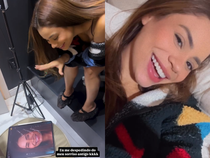 Sorriso repaginado! Lexa passa por procedimento para colocar lentes de porcelana