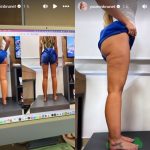 Yasmin Brunet mostra antes e depois após passar por tratamento contra lipedema