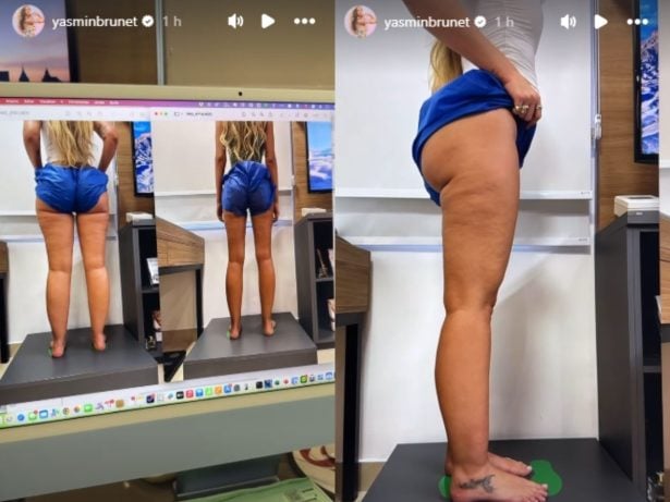 Yasmin Brunet mostra antes e depois após passar por tratamento contra lipedema