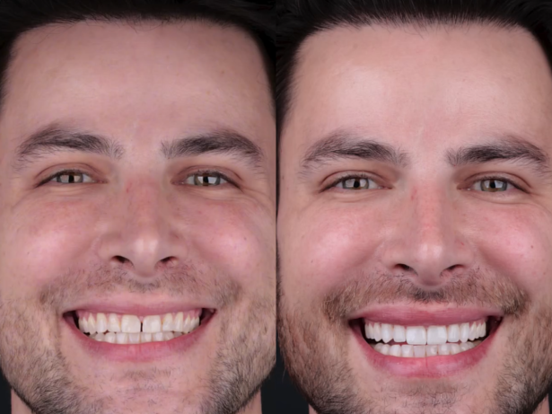 “Adeus, diastema!”: Gustavo Marsengo exibe novo sorriso prestes a se casar