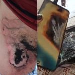 Celular explode em bolso e deixa homem com queimaduras de 3º grau em Avaré, São Paulo