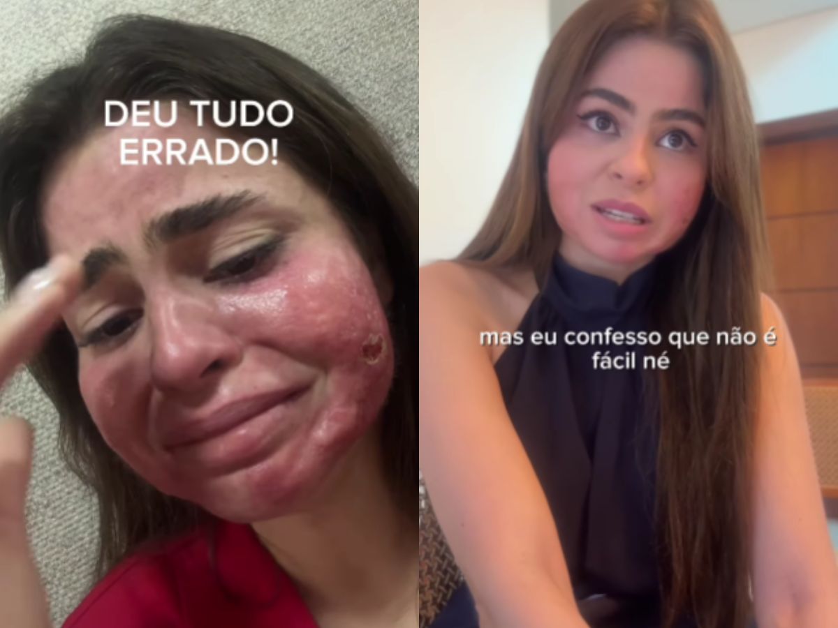 Médica desenvolve cicatrizes no rosto após peeling químico.  Reprodução Instagram 