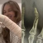 Sammy, ex de Pyong Lee, exibe novos registros da fratura na mão e impressiona